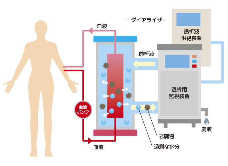 血液透析の図解